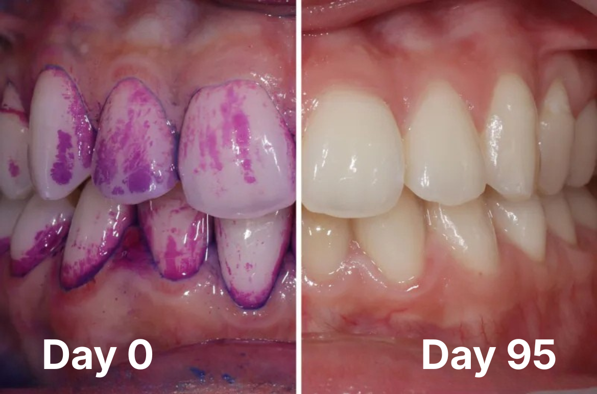 Patient B — before and after 95 days